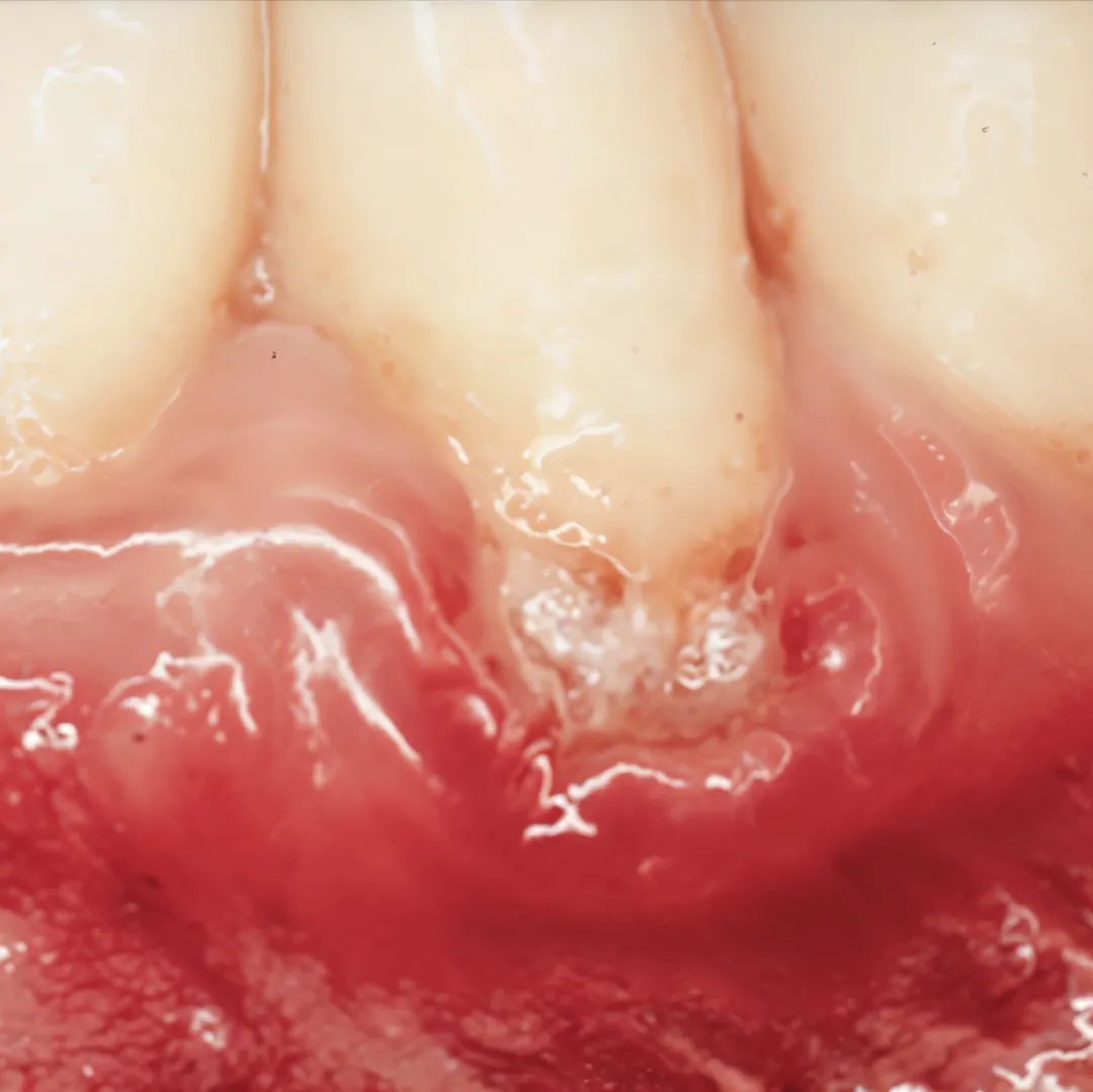 Gum Irritation