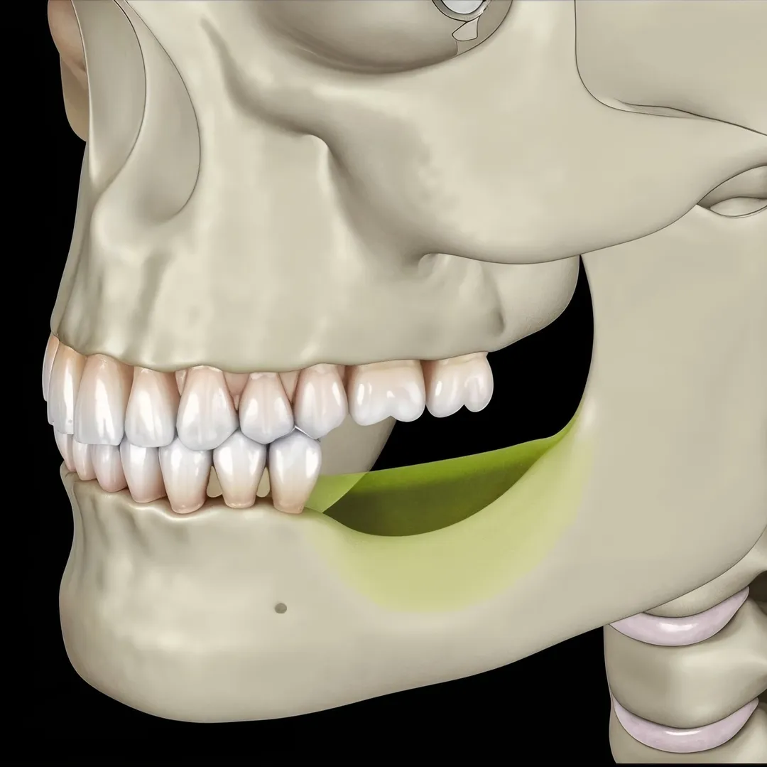 Residual Ridge Resorption -Bone Resorption 