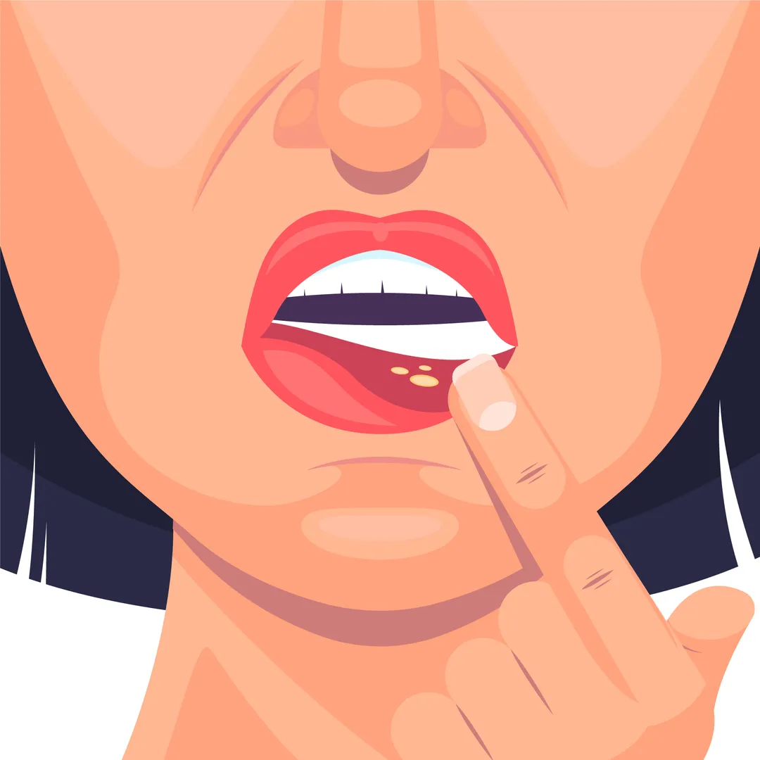 Allergic Reactions