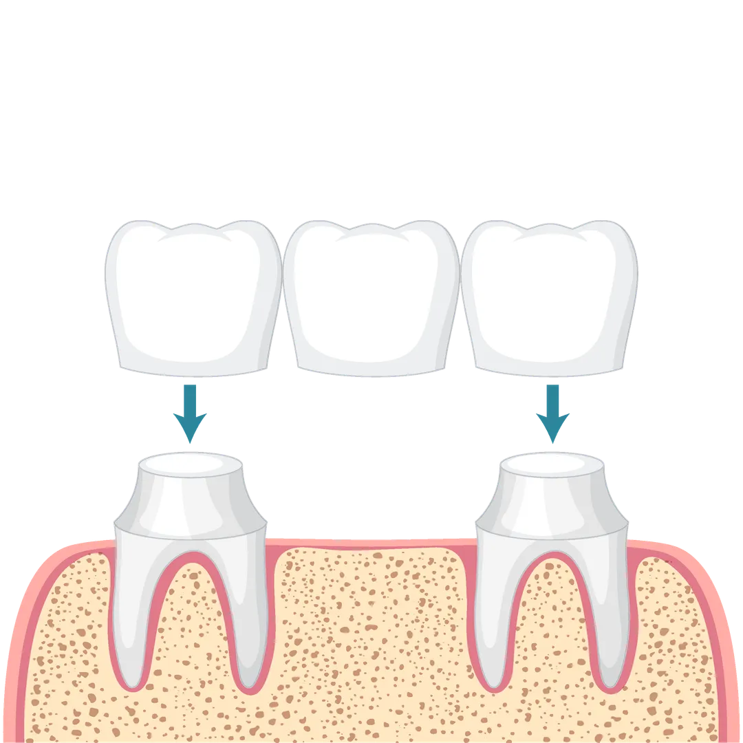 Dental Bridge