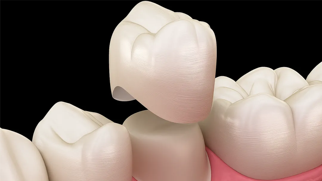 DO WE REALLY NEED A DENTAL CROWN?