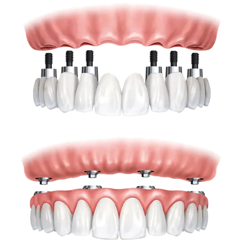 Immediate Dentures