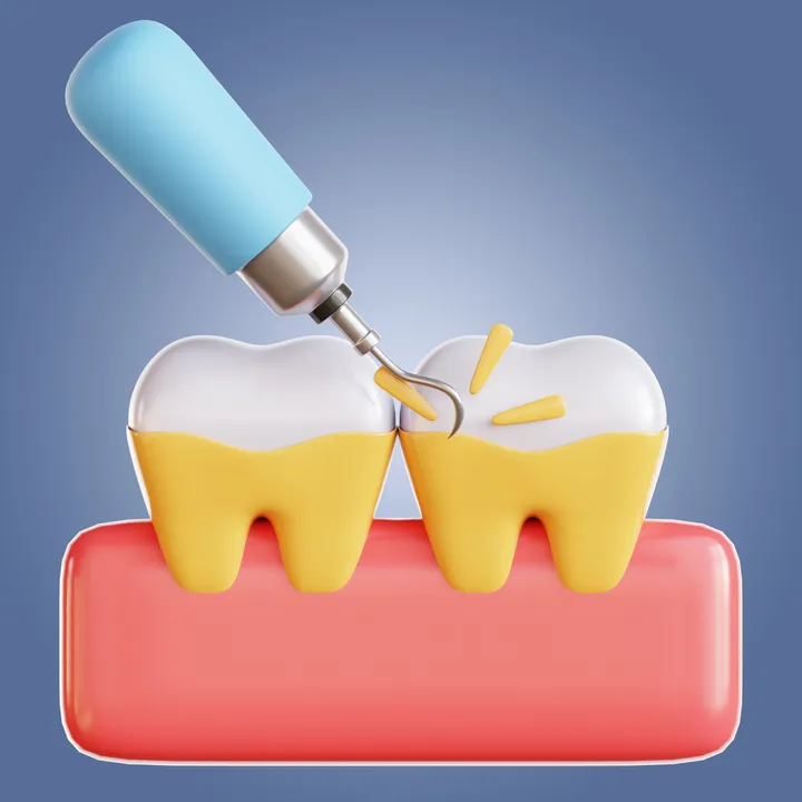 Scaling/Polishing- Dental cleaning