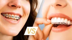 Article: Clear aligners vs traditional braces