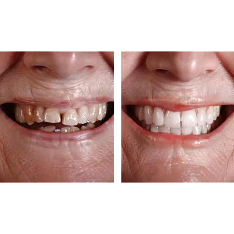 Smile Makeovers