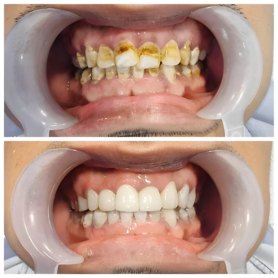 Before and after scaling treatment