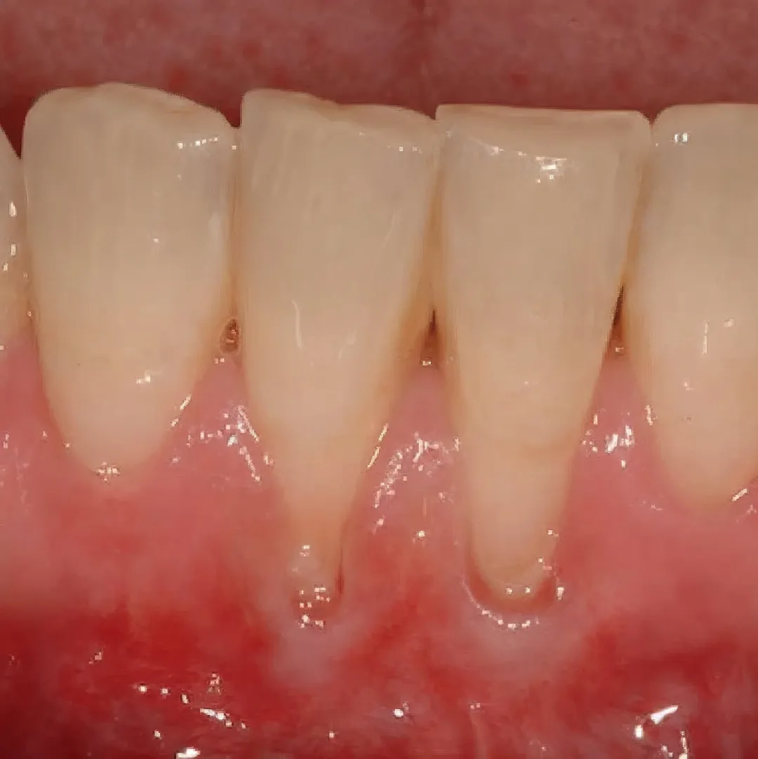 Recession of Gums