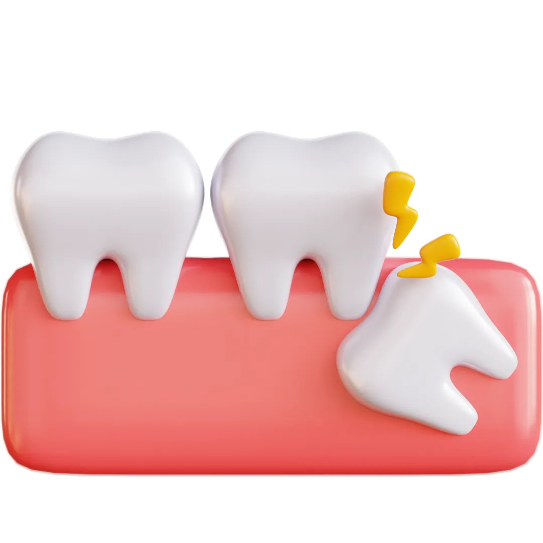 Image of impacted wisdom tooth