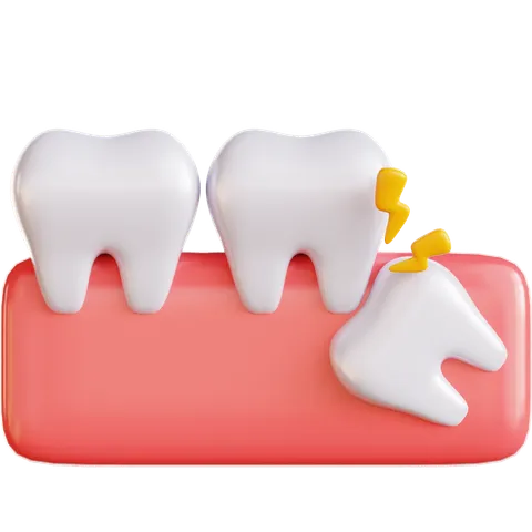Wisdom Tooth Extraction