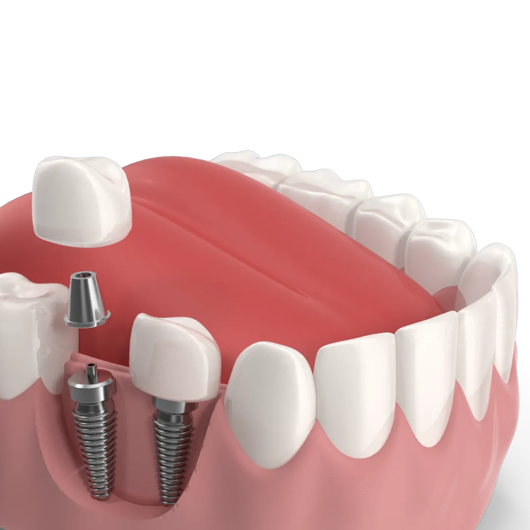 Implant 3d image