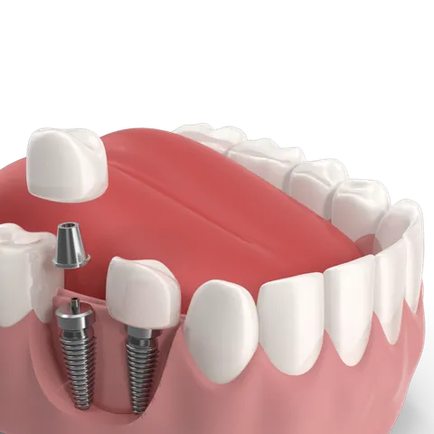 Dental Implants