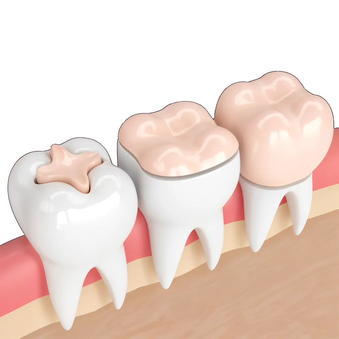 INLAYS AND ONLAYS -indirect restoration.
