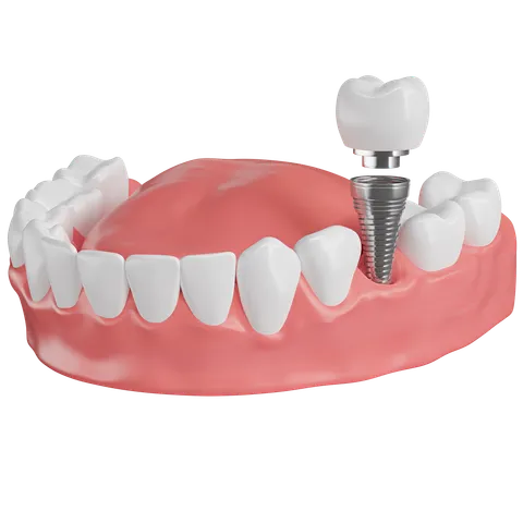 Dental Implant Fixing
