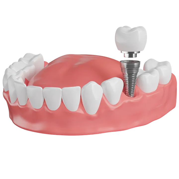 Dental Implant Fixing