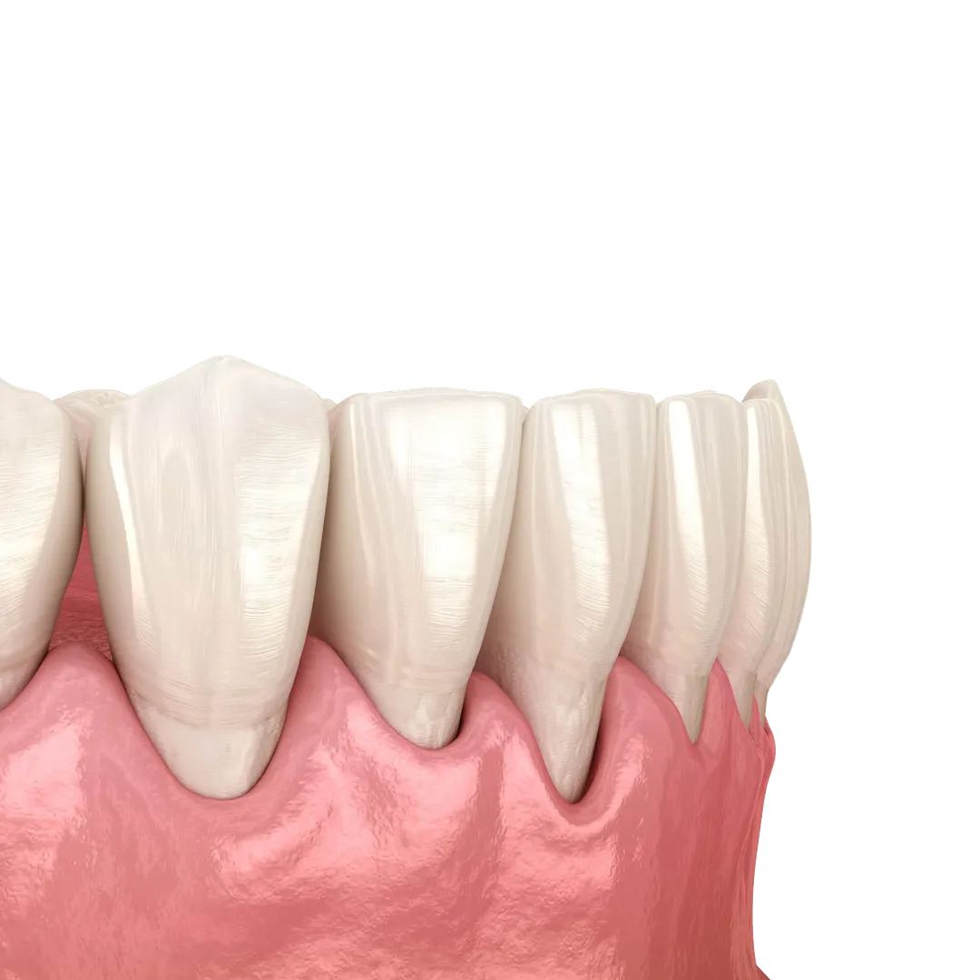 periodontitis