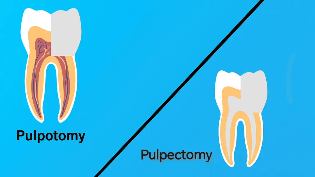 Pulpotomy and pulpectomy 