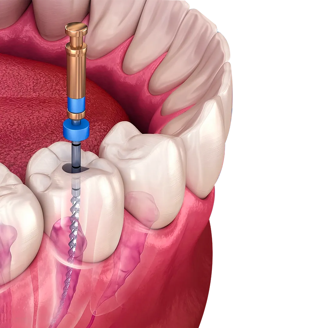 Root Canal Treatment Lateral View