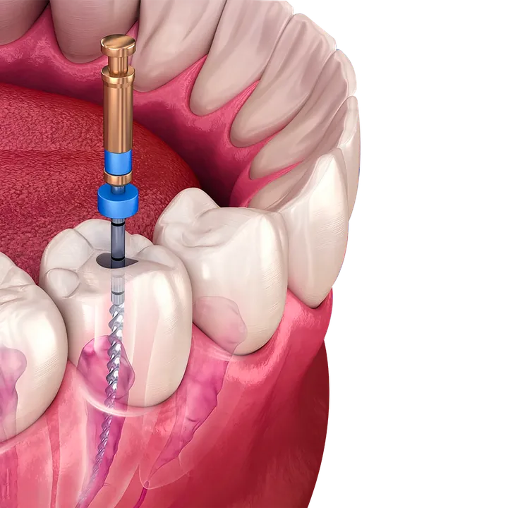 Root Canal Treatment