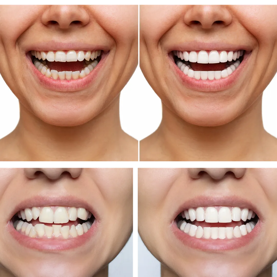 Smile Design - Before & After