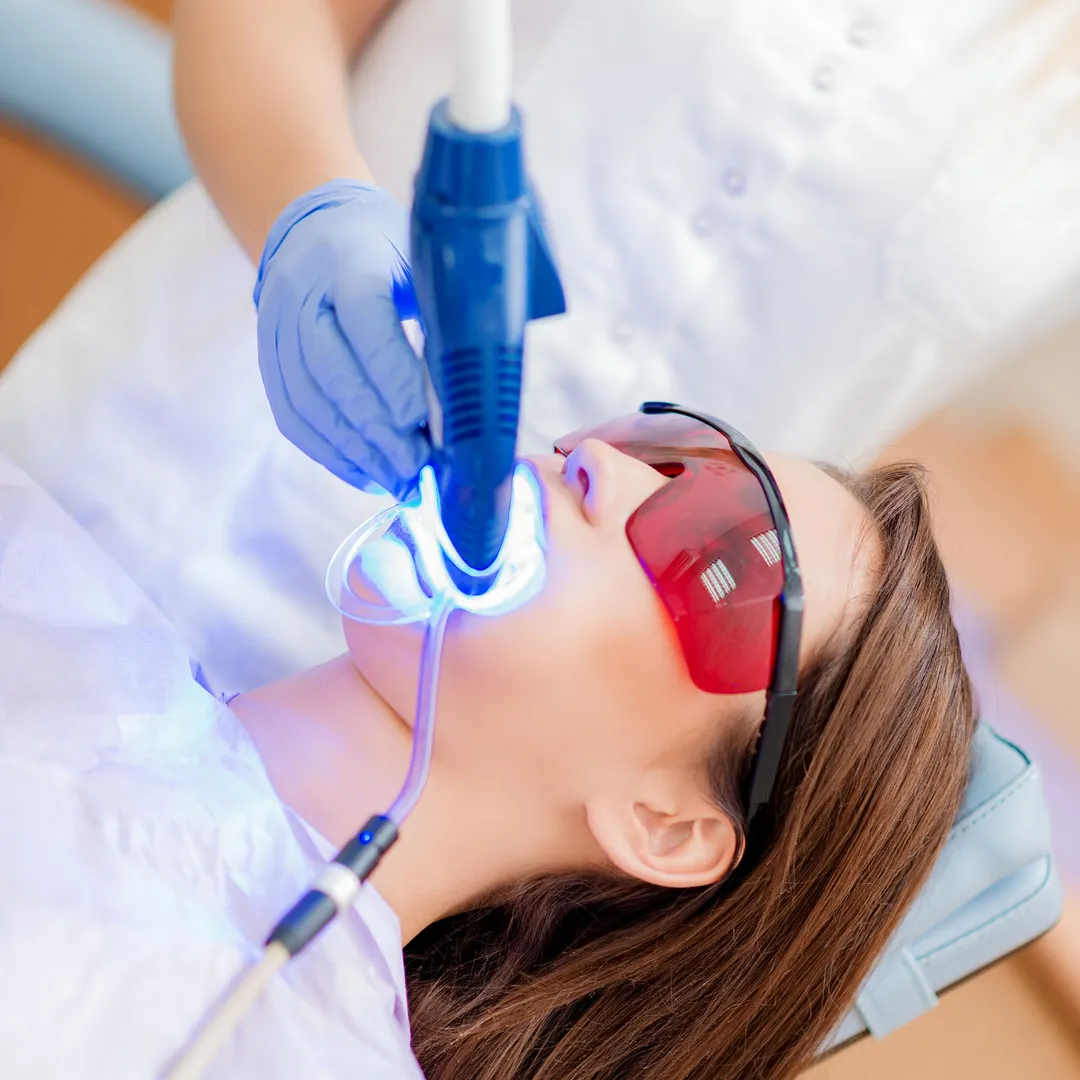 Laser Teeth Whitening