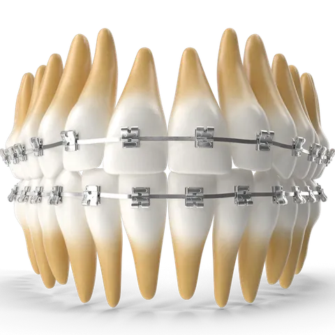 Straightening Teeth with Conventional Braces
