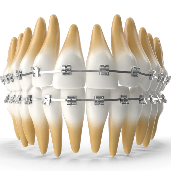 Straightening Teeth with Conventional Braces