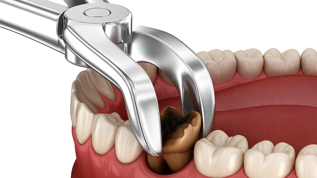 Tooth Extraction: when it is necessary?