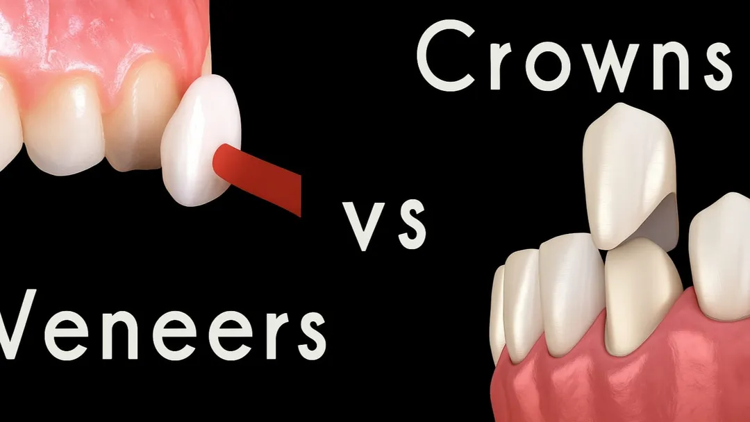 VENEERS VS CROWNS (pros and cons)