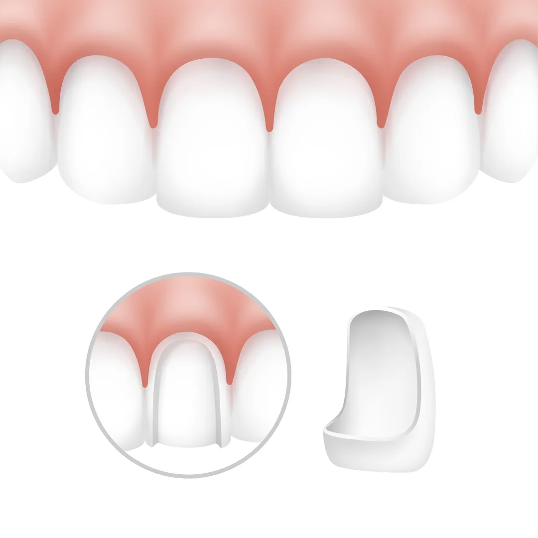 Porcelain Veneers